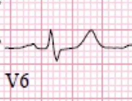 EKG