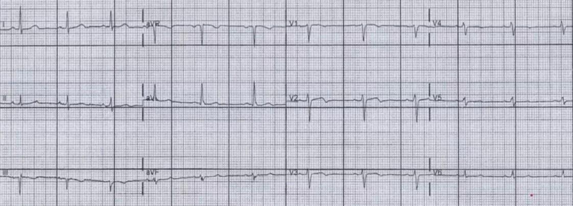 Kontrol EKG