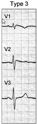 Brugada Sendromu tipleri Tip 3 tip 1 veya tip