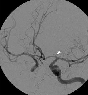 Anevrizma-dersler Multiple anevrizmalar %20 İntrakranial arterleri orjinden terminal uç dallara kadar izle