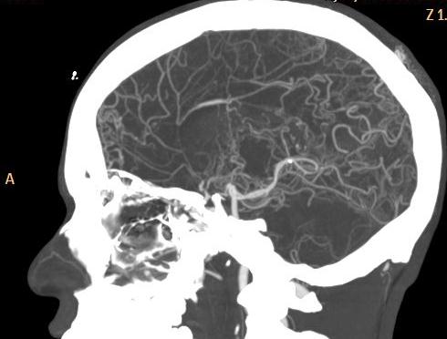 Arteritis