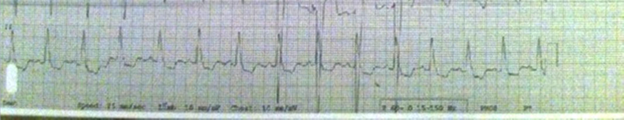 10. LBBB