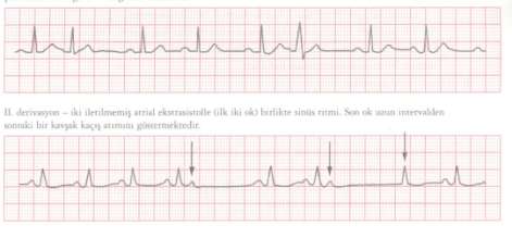 değil Çok erken gelirse ventriküle iletilmez (Bloke AEV) RBB