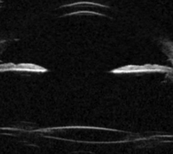 Resim 1.Afaki ve iridokapsüler adezyon mevcut 68 yaşındaki erkek hastanın sağ göz UBM görüntüsü.