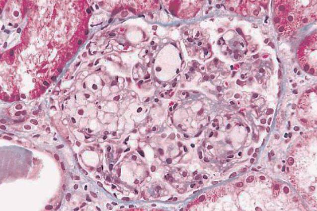 E2/E3 E2/E4 Tsimihodimos V, Elisaf M. Lipoprotein glomerulopathy. Curr Opin Lipidol.