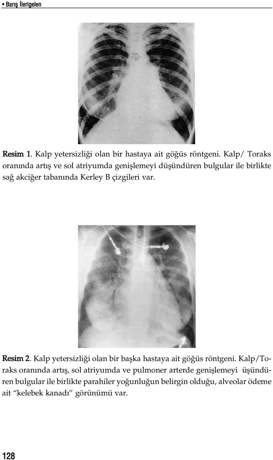 B çizgileri var. Resim 2. Kalp yetersizli i olan bir baflka hastaya ait gö üs röntgeni.