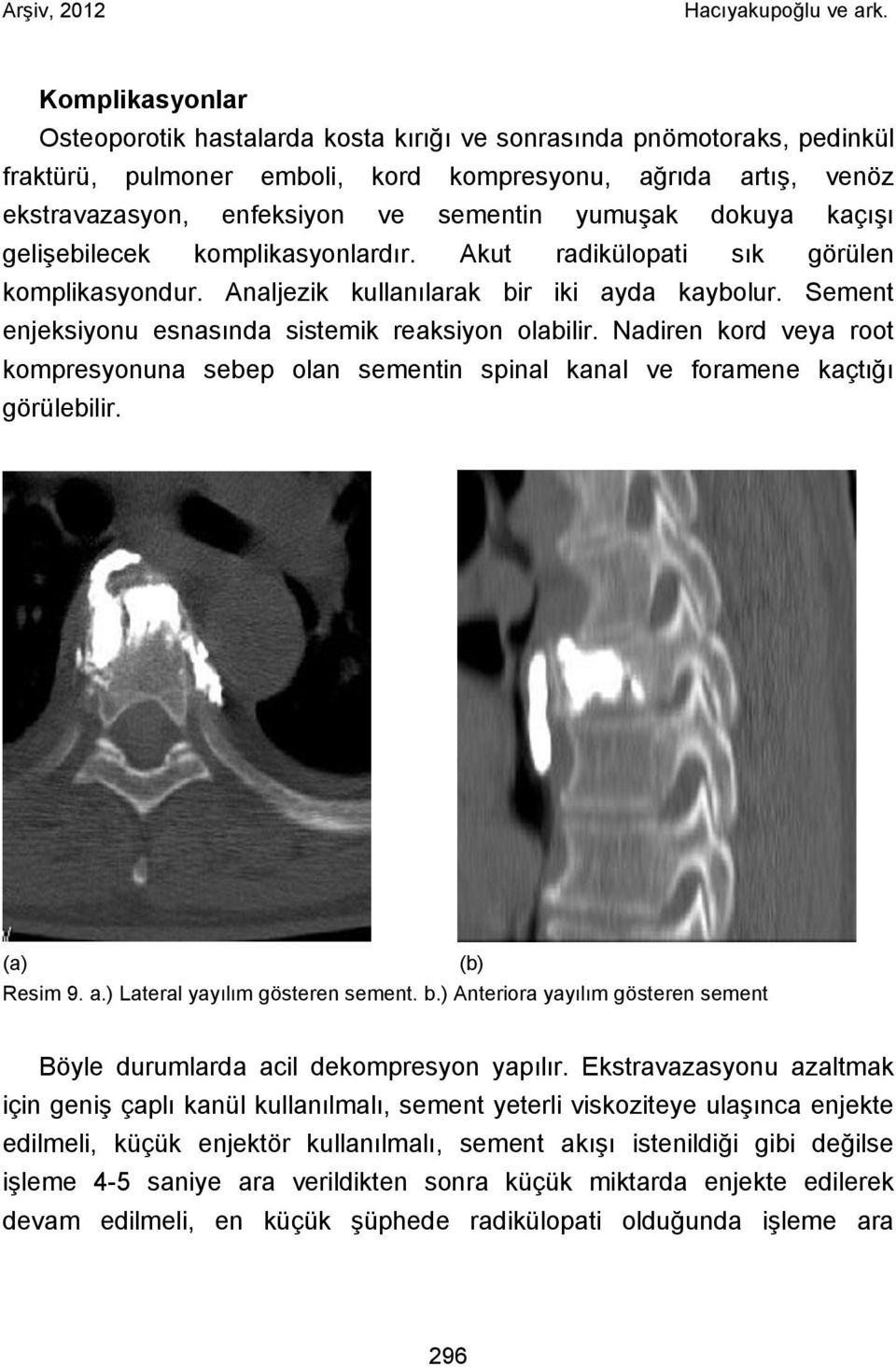 Sement enjeksiyonu esnasında sistemik reaksiyon olabilir. Nadiren kord veya root kompresyonuna sebep olan sementin spinal kanal ve foramene kaçtığı görülebilir. (a) Resim 9. a.