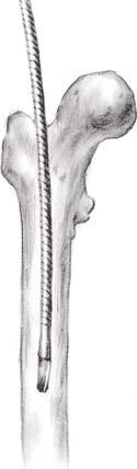 Accessing the Tbial Canal Tibial Kanala Eriþim A starting point is made either with a guide pin or an Cortical Awl (Ref:10606111002) based on surgeon preference.