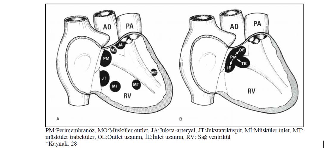 11 Modifiye Soto sınıflamasında ise inlet musküler septumdan triküspit anulusa doğru uzanan ve membranöz septumla direkt bağlantısı olmayan defektler jukstatriküspit nonperimembranöz olarak ifade