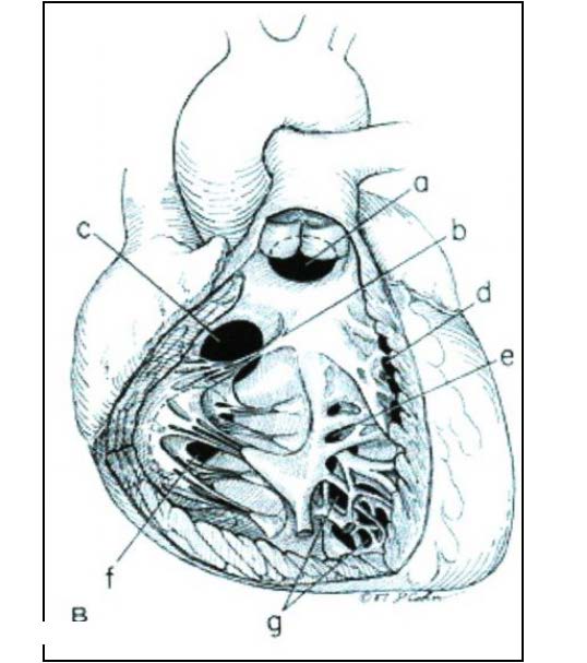 12 Şekil 2.3. Ventriküler septum defektlerinin sağ ventrikül tarafından görünümü.