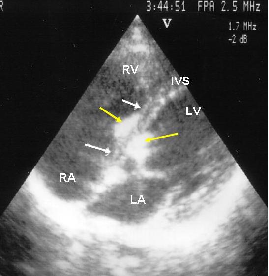 52 TV : Triküspit valvin RA : Sağ atriyum RV : Sağ ventrikül IVS : interventriküler septum LA : Sol atriyum LV : Sol ventrikül Şekil 4.2. 67 nolu vakanın transözefageal ekokardiyografi ile 4 lü pozisyondaki ekogramı.
