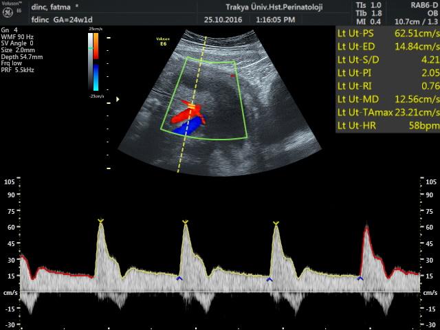 Antifosfolipid send Merz E, Ultrasound in Obstetrics and Gynecology, 2002 Martin AM, Ultrasound Obstet Gynecol 2001