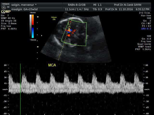MCA - IUGR CPR SGA >34 hf fetal distress acil C/S Kord ph düşük NICU SGA <34 hf Doğum haftası, ağırlığı,