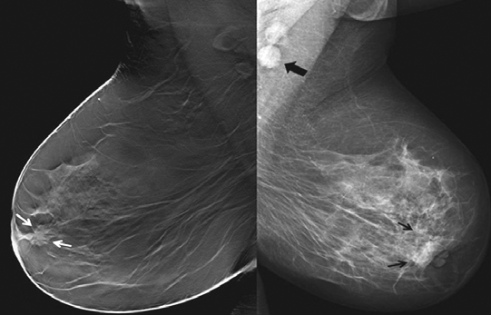 A B Şekil 1. 49 yaşında, bilateral senkron meme kanseri saptanan olguda kraniokaudal (A), sağ meme mediolateral oblik (MLO) tomosentez kesiti ve sol meme MLO mamogramlar (B) görülüyor.