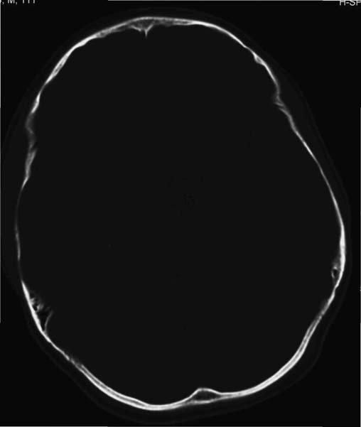 Epidural