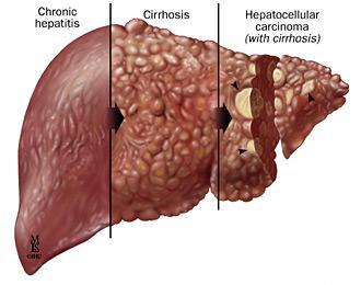 HCV Kronik hepatit Siroz