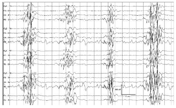 188 Çocukluk çağında epileptik ensefalopatiler SUPRESYON-BÜRST İLE BİRLİKTE OLAN ERKEN İNFANTİL EPİLEPTİK ENSEFALOPATİLER Ohtahara Sendromu Ohtahara sendromu, hayatın ilk aylarında sıklıkla yenidoğan