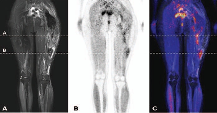 Agresif fibromatozis, 27 Y/K T1A