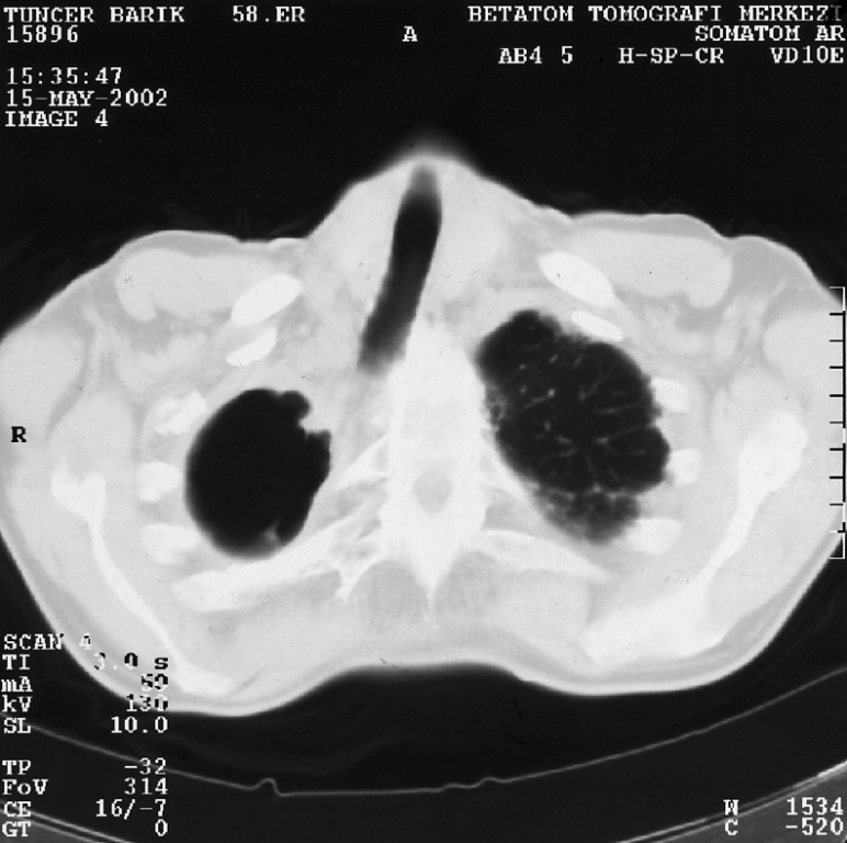 Şekil 3 : Tedavi sonrası akciğer grafisi.
