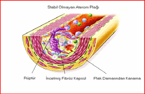 Komplike Aterom Plağı İnflamasyon Anjiotensin II Okside LDL Plak