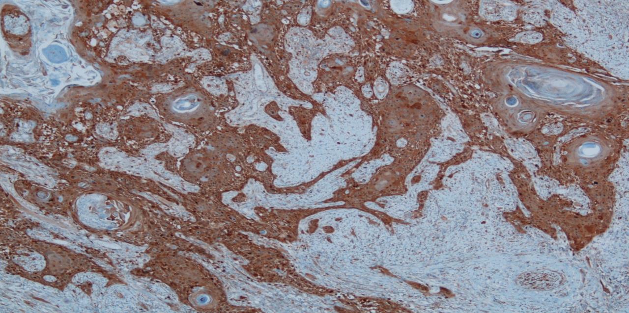 45 Şekil 4.3. Skuamöz hücreli karsinomda orta şiddette sitoplazmik galektin-3 pozitifliği (Biyopsi No: 4875/08, Hasta No: 20) (x200). Şekil 4.4.