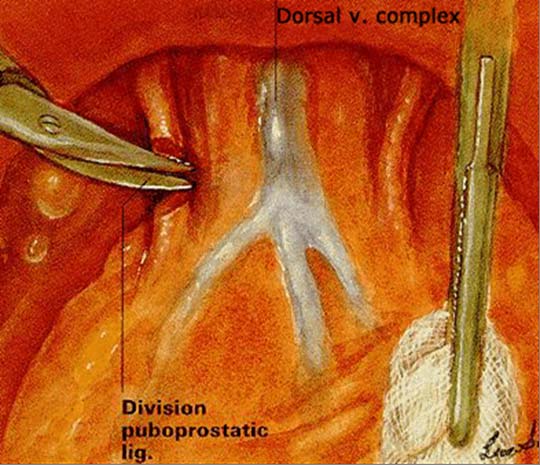 Radikal Retropubik Prostatektomi Tekniği