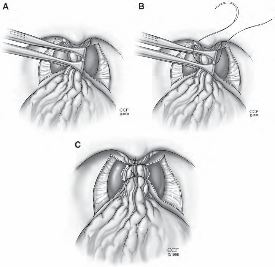 Radikal Retropubik Prostatektomi Tekniği Derin dorsalvenbabcock klemp yardımıyla biraraya toplanır (BUNCHİNG).