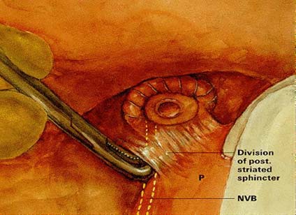 Radikal Retropubik Prostatektomi Tekniği Apikal disseksion tamamlanıp üretra kesilir.