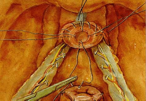 Radikal Retropubik Prostatektomi Tekniği Mesane boynu anteriordan koterle insize edilir.