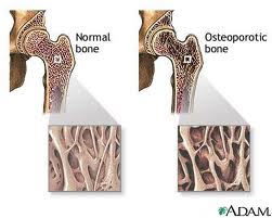 Heparin osteoporoz yapıyor DMAH in yan etkileri daha az ve daha seyrek