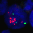 Pharmacogenetics = molecular DD Case Study: Herceptin Bimodal