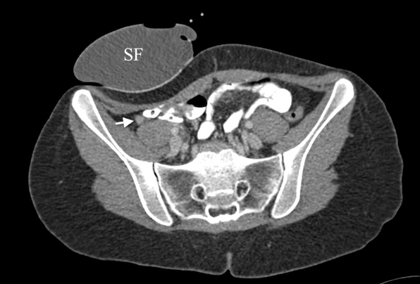 15 Şekil 4.1. Akut apandisit varlığı cerrahi ve patolojik olarak doğrulanan 66 yaşındaki erkek hastaya ait kompresyonlu abdomen BT görüntüleri.