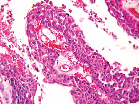 Türk Onkoloji Dergisi (a) (b) Şekil 2. Sitolojik olarak malignite şüphesi tanısı alan düşük dereceli papiller ürotelyal karsinom olgusuna ait sitolojik ve histolojik görünümler.