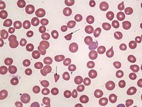 Haptoglobin D.