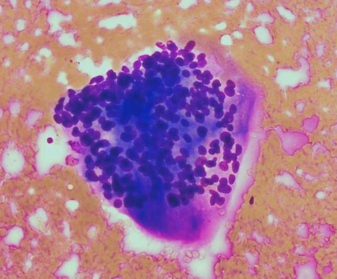 Multinükleer dev hücreler Görülmedi; Tipik intranükleer