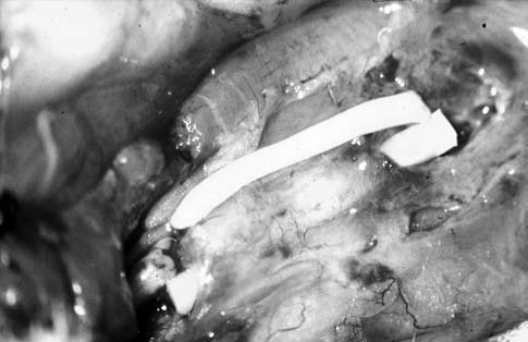 132 Acta Orthop Traumatol Turc 1 2 a a 3 4 Şekil 1. Biyolojik membran içinde silikon implant. a: Proksimal ve distal sinir uçları. kildi (Şekil 2).