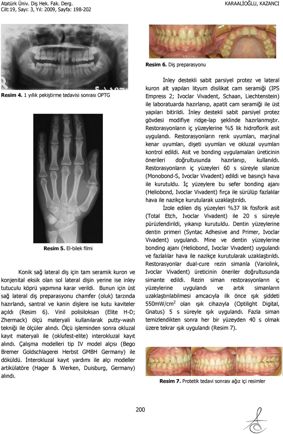 Bunun için üst sağ lateral diş preparasyonu chamfer (oluk) tarzında hazırlandı, santral ve kanin dişlere ise kutu kaviteler açıldı (Resim 6).