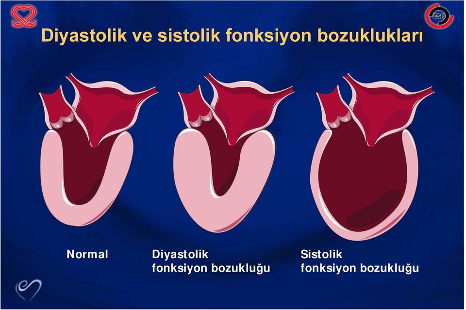 Normal Diyastolik fonksiyon