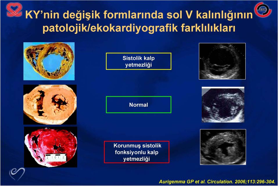 kalp yetmezliği Normal Korunmuş sistolik fonksiyonlu