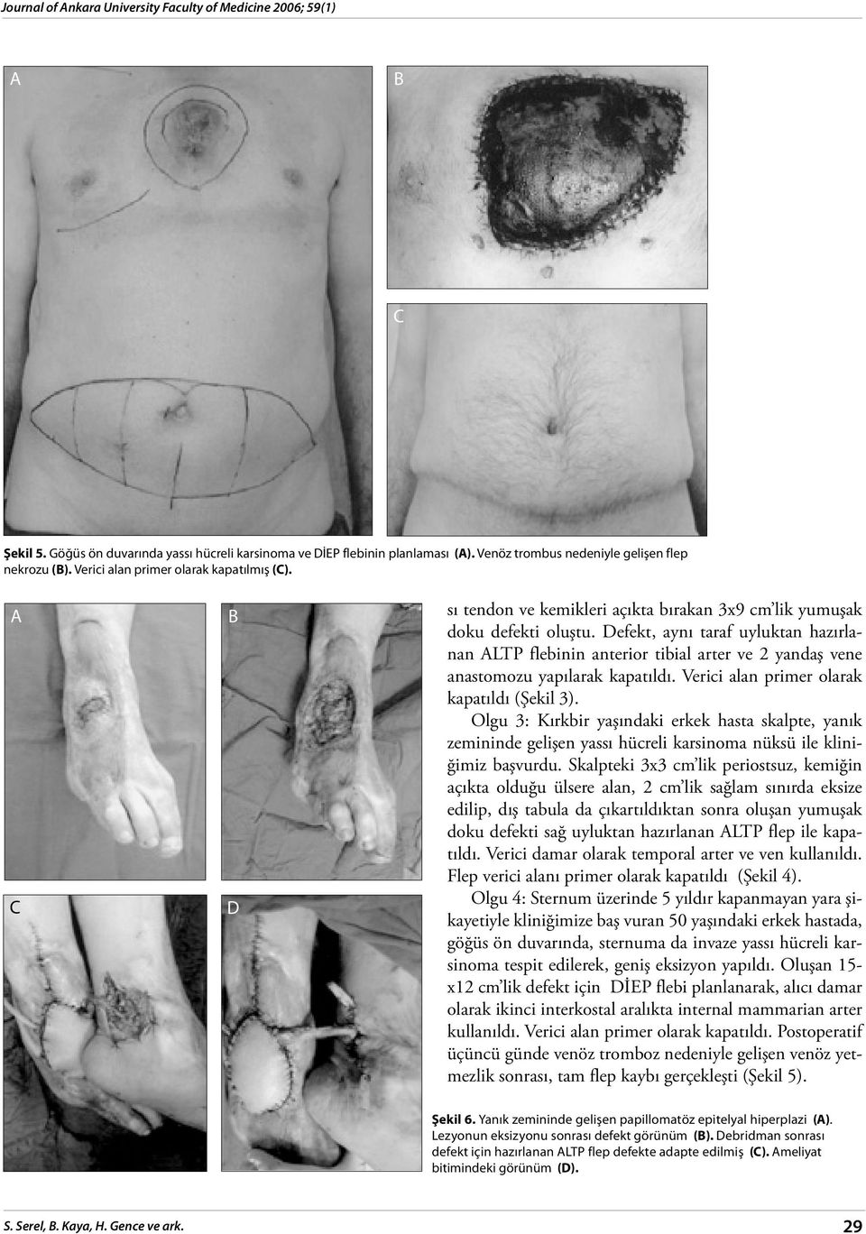 efekt, aynı taraf uyluktan hazırlanan LTP flebinin anterior tibial arter ve 2 yandaş vene anastomozu yapılarak kapatıldı. Verici alan primer olarak kapatıldı (Şekil 3).