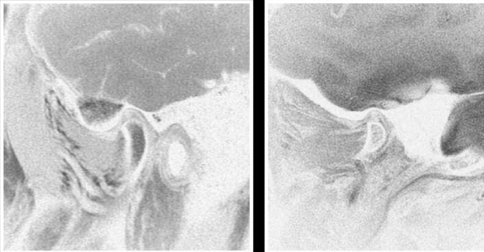 iyonize radyasyon kullanılmadığından dolayı implant uygulaması öncesi değerlendirilmelerde ve gömülü alt yirmi yaş dişi cerrahisi öncesi dişle mandibuler kanalın ilişkisinin belirlenmesinde de