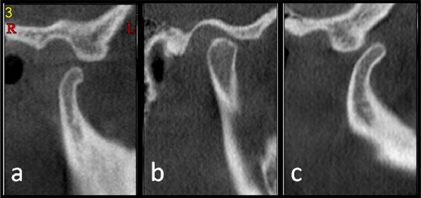 Kondiler kemik değişiklikleri: a) Normal kondil (yuvarlak tip), b) düzleşme c) osteofit d)