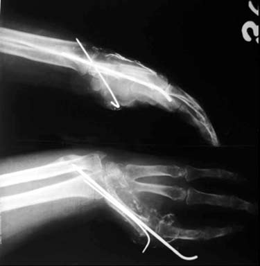 288 Acta Orthop Traumatol Turc (a) (b) (c) Şekil 1. (a) Kemik fibrosarkomu olan olgunun ameliyat öncesi görüntüsü. (b) Olgunun manyetik rezonans görüntüsü.