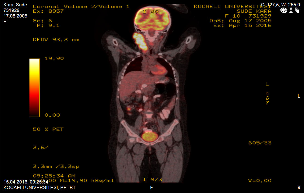 PET SONUÇ ve YORUM: Sağ servikal bölgede supraklavikular bölgeye uzanan malignite düzeyinde yoğun artmış metabolizma gösteren konglomere lenfadenopati izlendi (metastaz?/primer?).