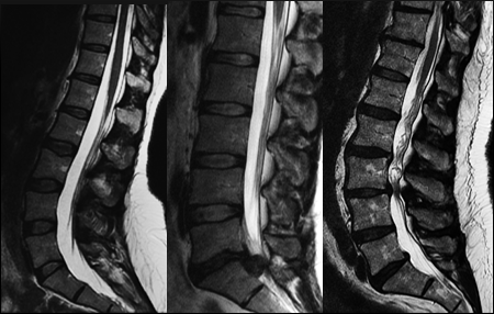 stenoz Spinal kord patolojisi Omurga; Vertebralar, İntervertebral diskler ve ligamanlar Dejeneratif ve morfolojik değişiklikler Bu değişiklikler birçok açıdan birbirlerine bağlı Aynı neden; kronik