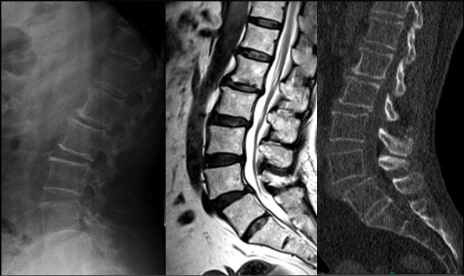 DEJENERATİF SPONDİLOLİSTEZİS: SPONDİLOLİSTEZİS-GRADE Posterior spondilolistezis: Faset ve disk dejenerasyonu Mobil spinal segment:servikal ve üst lomber seviye