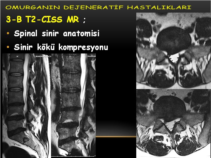 Foraminal stenoz Normal yükseklik;19-21 mm Sagital çapı;7-8 mm Stenoz< 3 mm Foraminal stenoz Wildermuth ve ark; Kalitatif derecelendirme Grade 0: Normal: normal yağlı planlar Grade