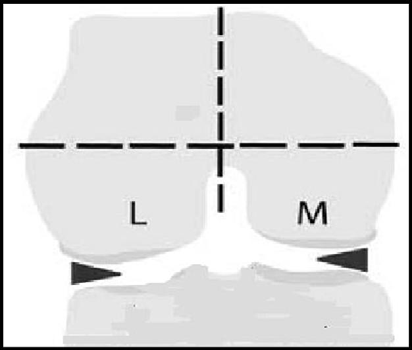 Patella patellar tepe noktası sınır kabul edilerek medial faset (M) ve lateral faset (L) olarak ayrıldı (Şekil 3.4.1). Karşı kortekse kadar tüm kemik patellanın subkortikal bölümü olarak kabul edildi.