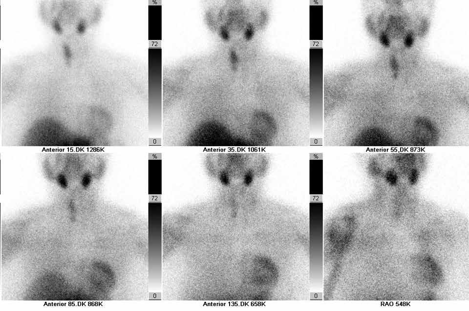 Persistan primer hiperparatiroidi gelişiminde etkili risk faktörleri Resim 5: Olgu 6 da ilk ameliyat sonrası yapılan MIBI sintigrafide geç görüntülerde sağ tiroid lobu inferiorundaki zayıf MIBI