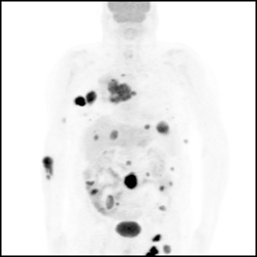 metastazlar: A-Koronal pozitron emisyon tomografisi füzyon